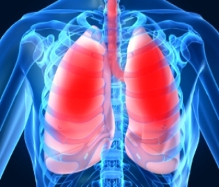 Туберкулоза : Туберкулоза - бели дробове, заразно, 