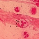 Много смъртни случаи от A (H1N1) са дължат на вторична инфекция - 