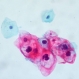 Комбинацията от цитонамазка и HPV тест е сигурна при нередовна профилактика - 